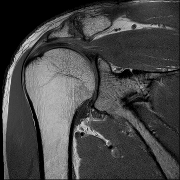 MRI Pathology Common In Patients' Symptomatic And Pain Free Shoulders — Mend