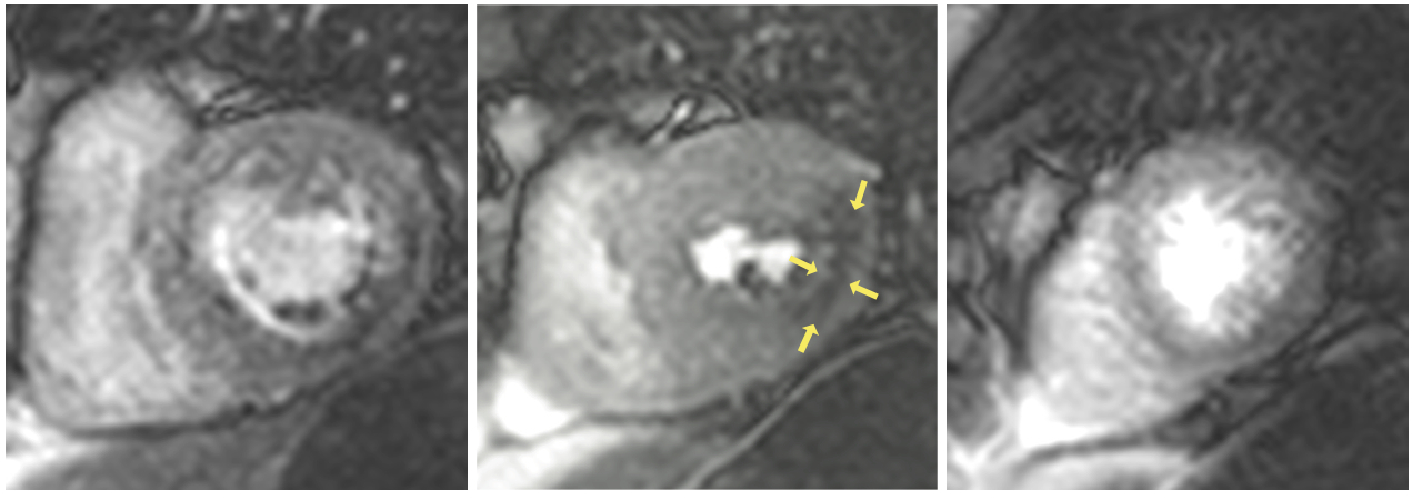 Three slices of 2D perfusion MRI With a perfusion defect marked by the yellow arrows. Courtesy of Prof. Eike Nagel, King’s College London. 
