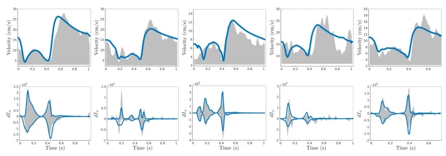 An example of 1D coronary flow model fitted to patient-specific data. Bottom row shows that coronary wave intensities can be accurately reproduced