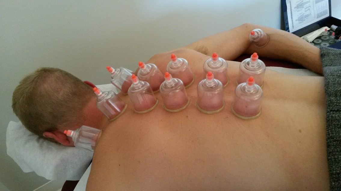 I also had the bizarre pleasure of getting cupped at www.shendaoacupuncture.ca