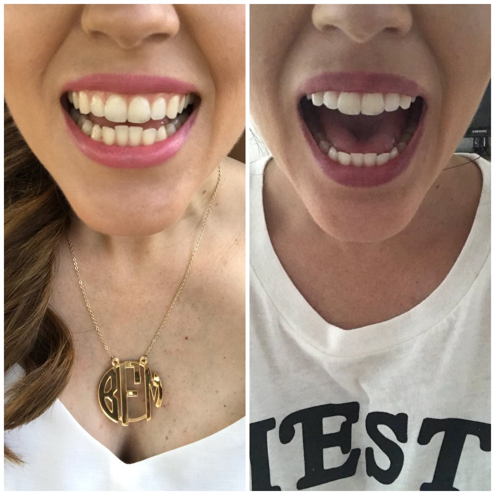 Smile Club Direct Before After Things To Know Before You Buy