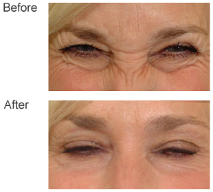 horizontal wrinkle between eyes