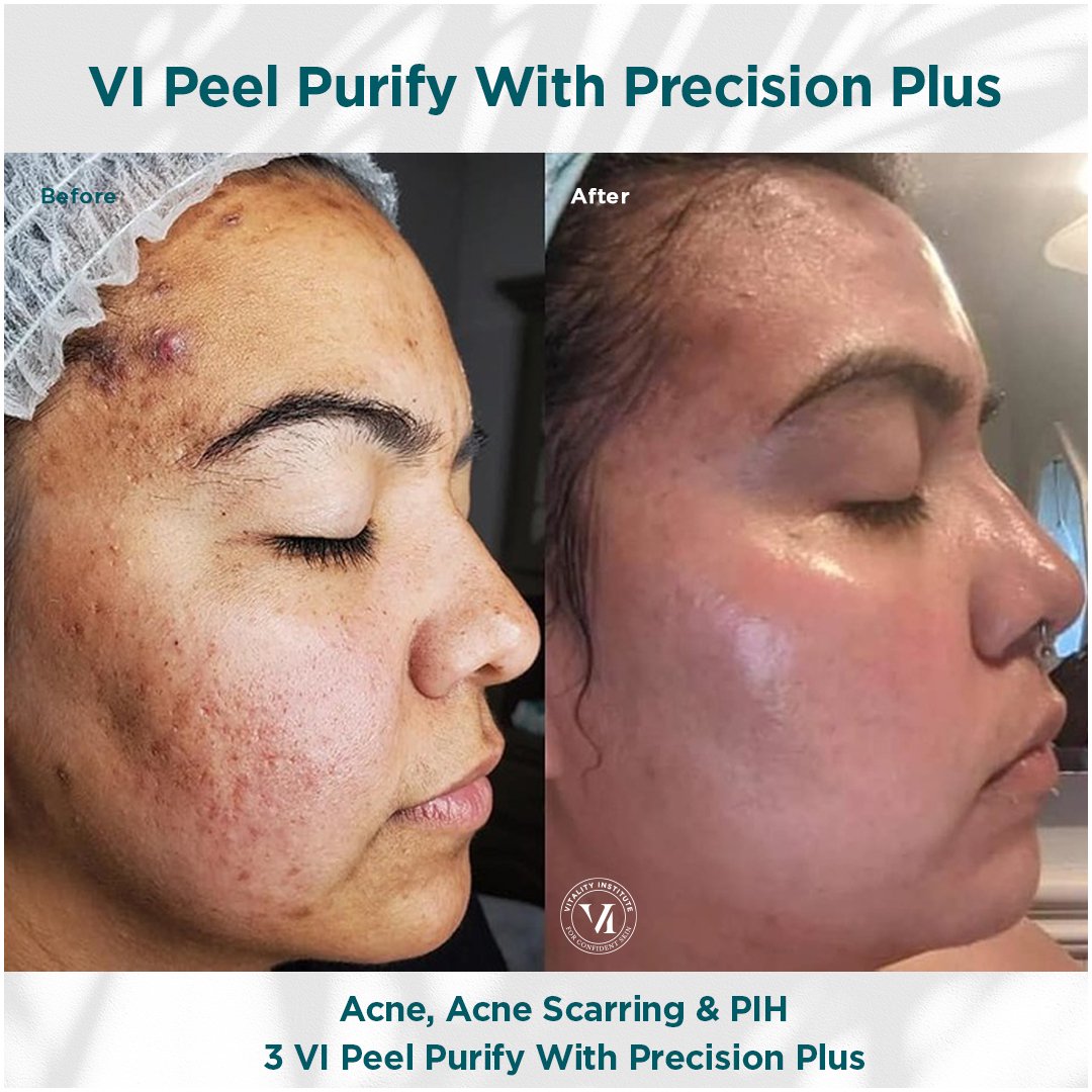 Acne, Acne Scarring _ PIH_03.jpg