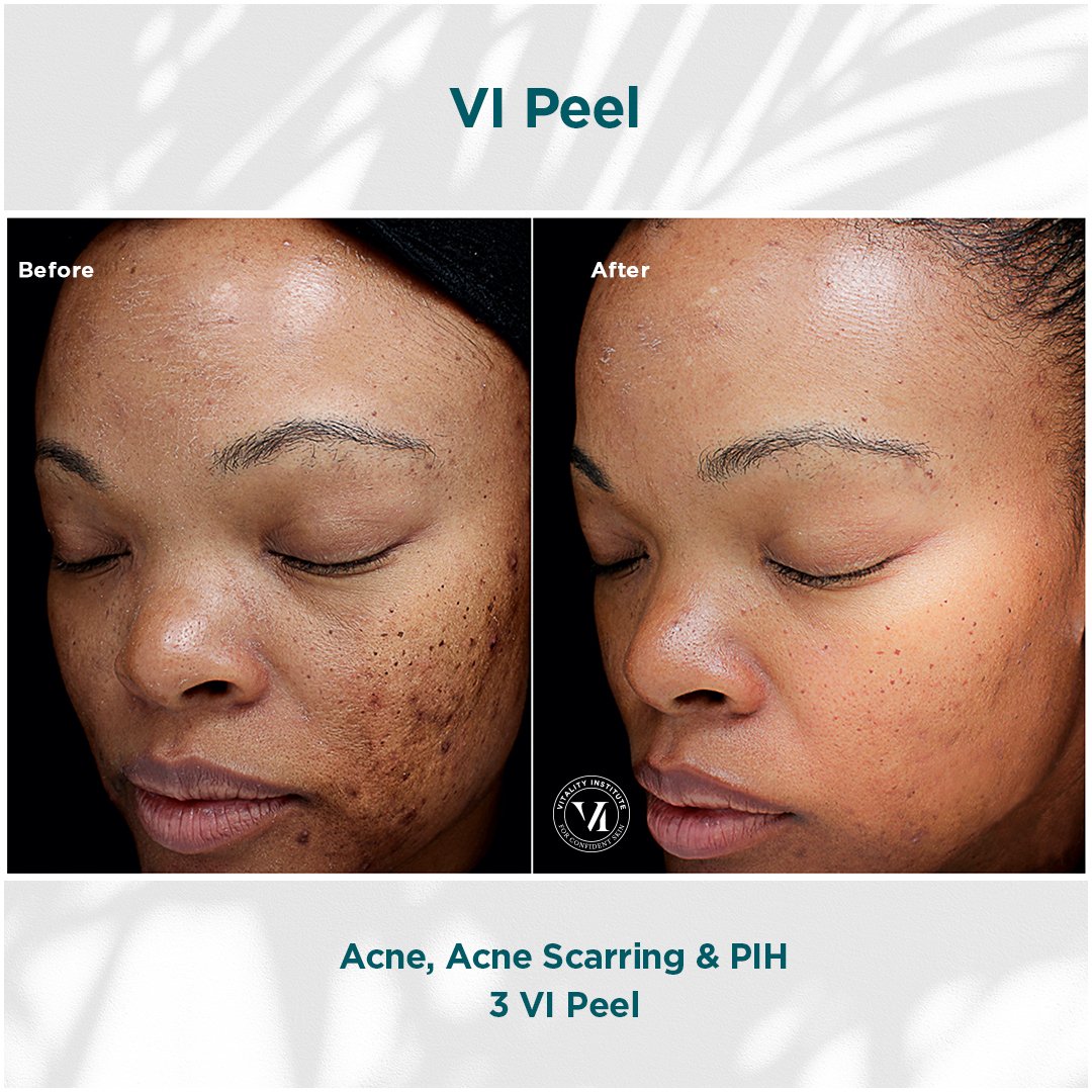 Acne, Scarring _ PIH_01.jpg