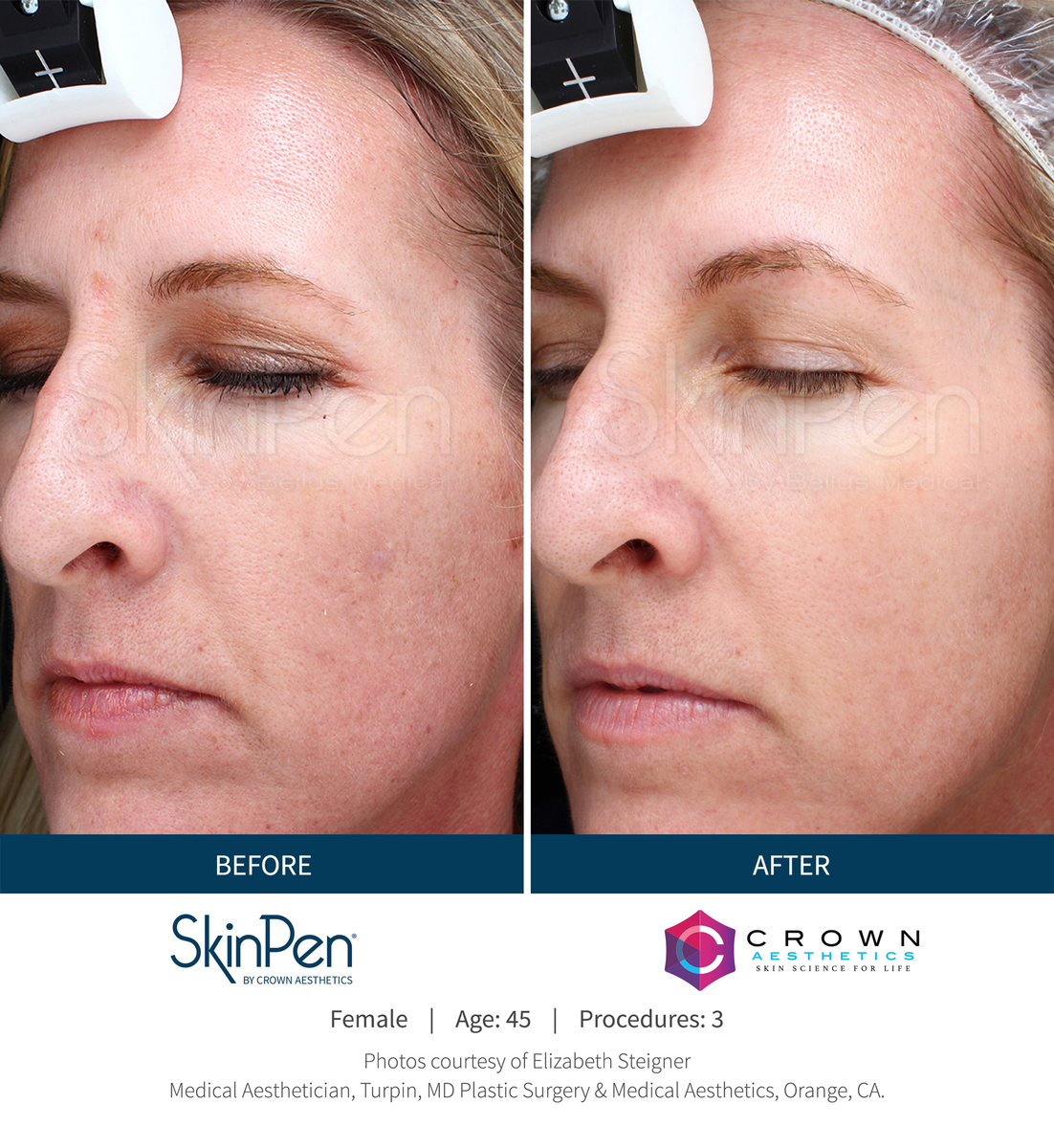 Before-and-After-Picture-CA-1_preview_maxWidth_1200_maxHeight_1200_ppi_72.png