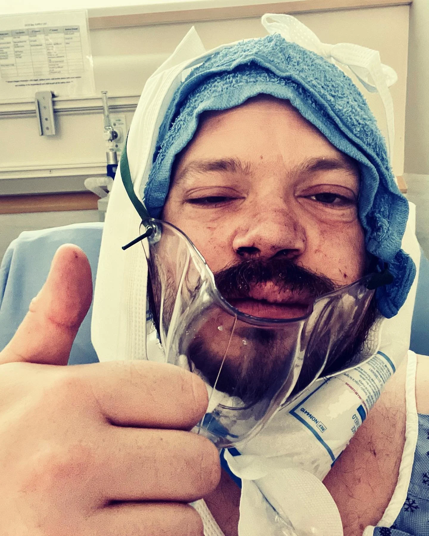 On May 15th, I underwent maxillomandibular advancement surgery (double jaw surgery). The procedure involves breaking both the upper and lower jaw, advancing them forward by approximately 11mm, and securing them in the new position with screws and pla