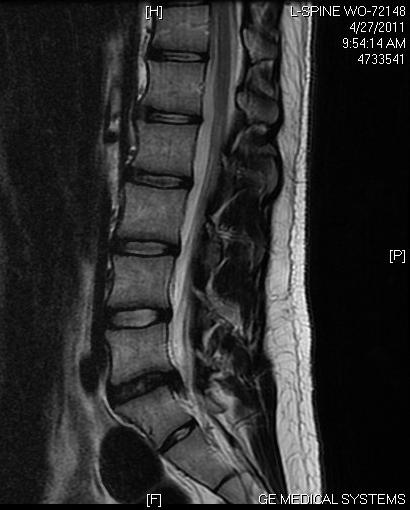 arthrose — Décompression neurovertébrale — MARGUIN OSTEOPATHE PARIS 6