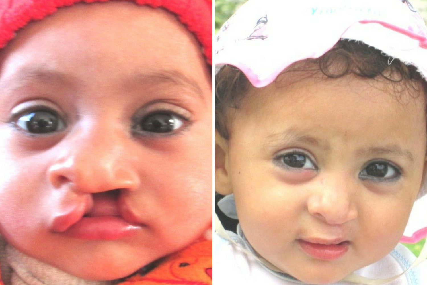 Muntaha, before her surgery, left, and, right, after the operation 