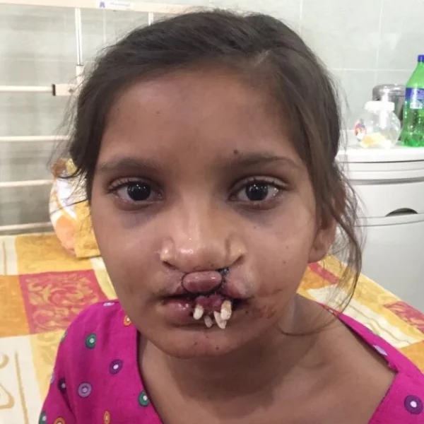 Maria in 2017 following the first operation to close her lip