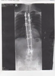 Photo of Julie Wilkins post surgery. Fused from T3-L3 with Cottrell Dubosset instrumentation. Notice the remaining lumbar curve which measures approximately 23 degrees.