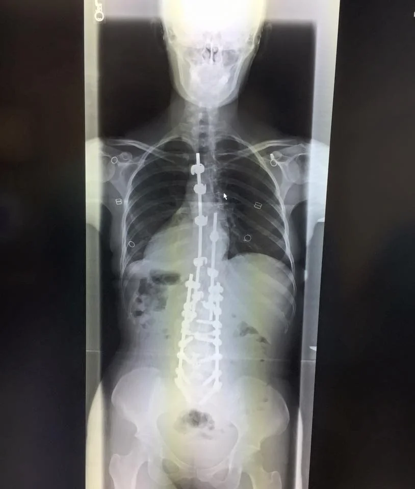 Amanda after her 3rd (and final!) Spine Fusion surgery 