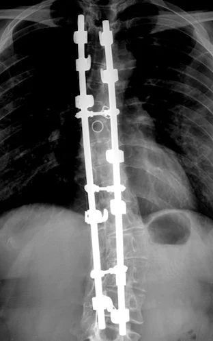 What Do I  Need After Spinal Fusion Surgery ?