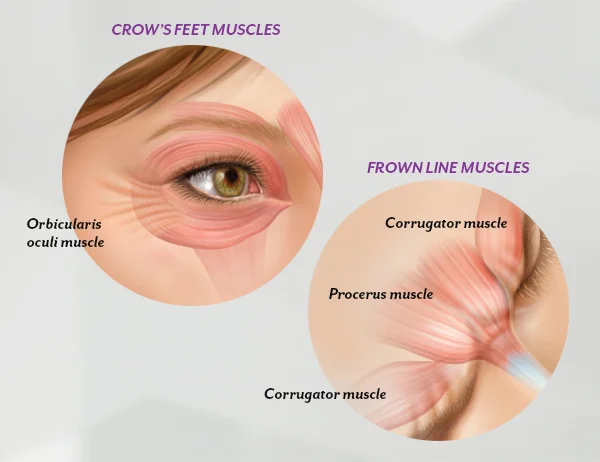 Wrinkles result from a combination of many factors. It’s not just about cellular changes that can occur over time, reduction of collagen, or damage caused by free radicals in the sun and the environment. When you frown or concentrate, the muscles between your brows contract, causing your skin to furrow and fold. And when you squint, the muscles around your eyes contract and cause crow’s feet. BOTOX ® Cosmetic works beneath the skin’s surface and targets the underlying muscle activity that causes frown lines and crow’s feet.