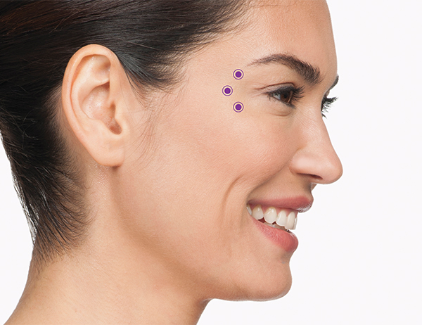 For the crow’s feet area, your specialist will inject 3 areas of the orbicularis oculi, the muscle that frames the side of the eye. This will be repeated on the orbicularis oculi muscle on the other eye. Injecting BOTOX ® Cosmetic into the muscles that cause crow’s feet lines temporarily reduces the activity of those muscles. The result is a reduction in the appearance of those lines.