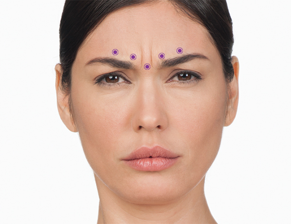 For the frown lines area, your specialist will administer 5 injections into muscles in your forehead—1 in the procerus muscle and 4 in the corrugator muscles. Injecting BOTOX ® Cosmetic into the muscles that cause frown lines temporarily reduces the activity of those muscles. The result is a reduction in the appearance of those lines.