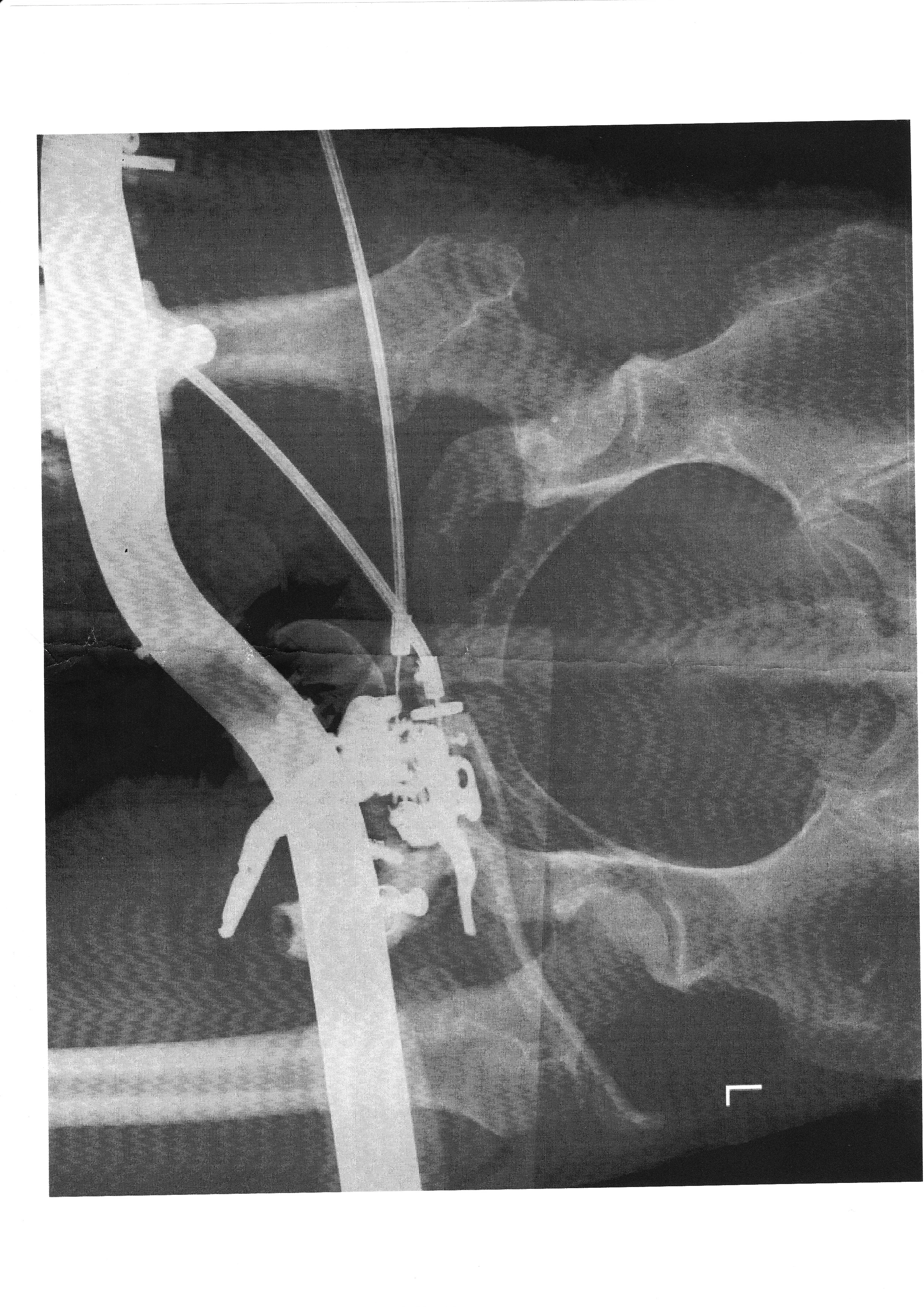 Thigh xray1