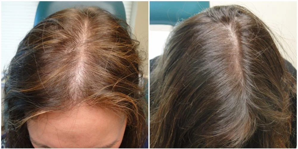 PRP : Before After