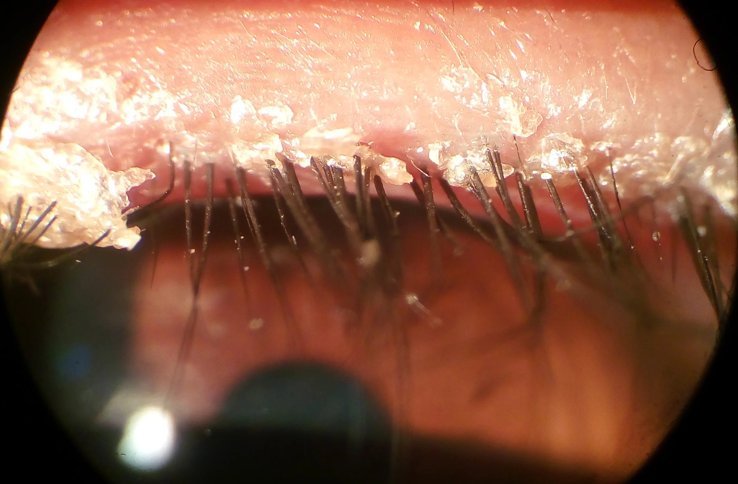 Scaling and bacterial debris at the base of the eyelashes