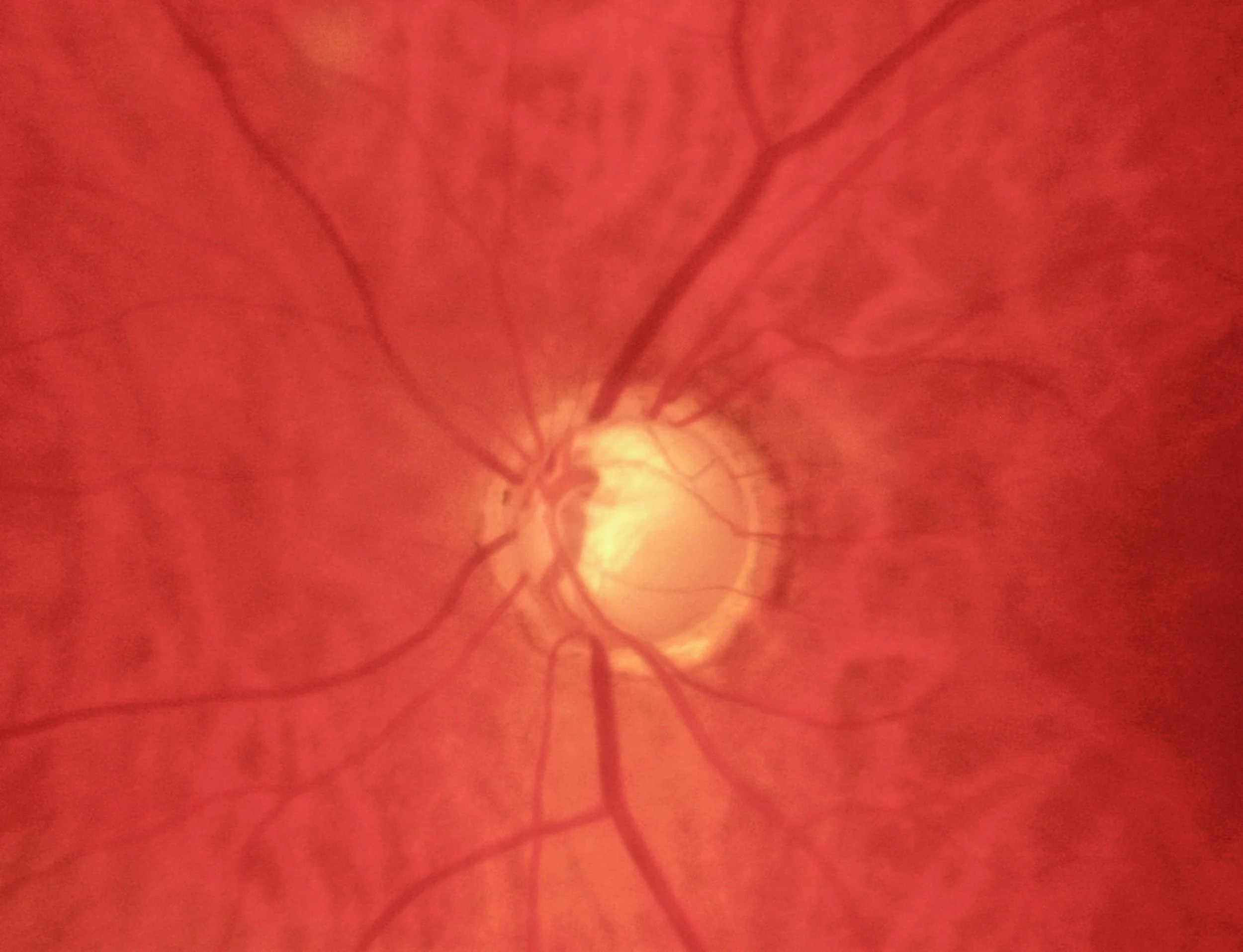 Optic nerve head cupping, which is a sign of thinning of the nerve fibers.