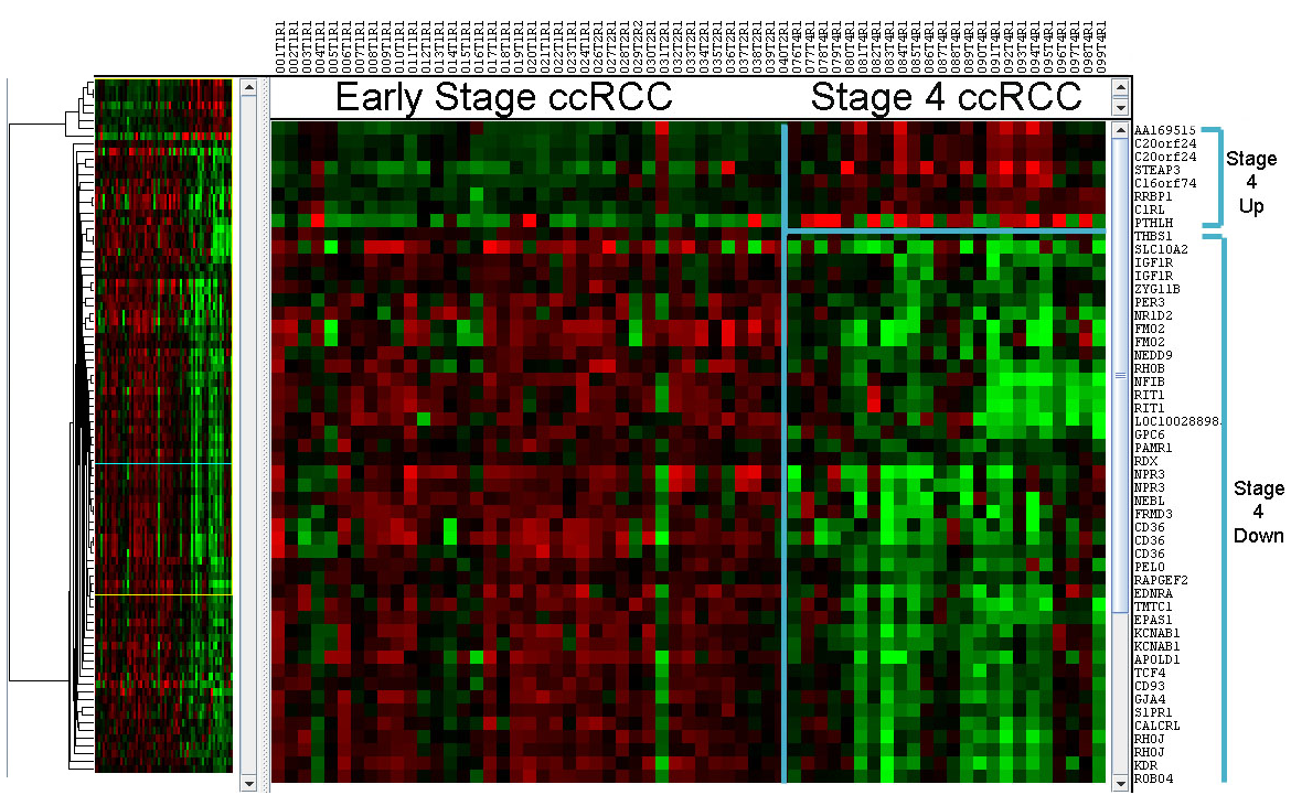 Differentially expressed genes in clear cell renal cell carcinoma (ccRCC), early stage vs. late stage. Red - upregulated, green - downregulated. 