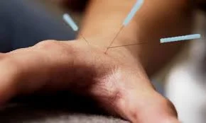 acu hand.jpeg