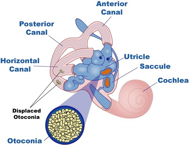 Treatment Of Benign Paroxysmal Positional Vertigo Bppv — Best