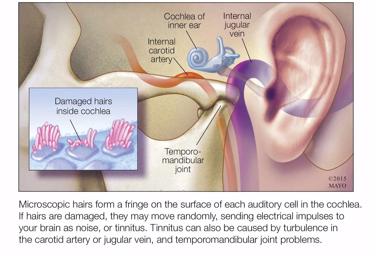 Tinnitus.jpg
