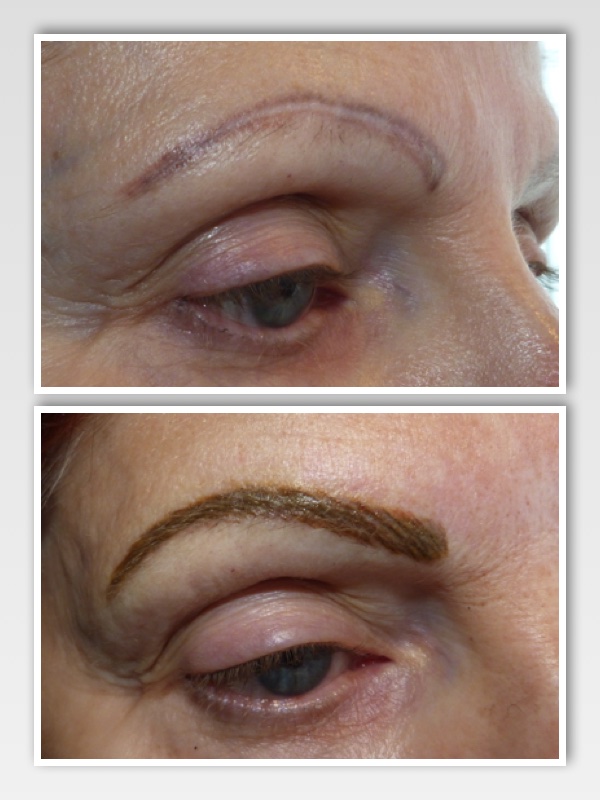 Client presented with previously tattooed eyebrows. They were asymmetrical, had turned purple and were done using incorrect technique and poor color selection. The faded result left the borders strong and the middle blank with a purple hue to the color. 