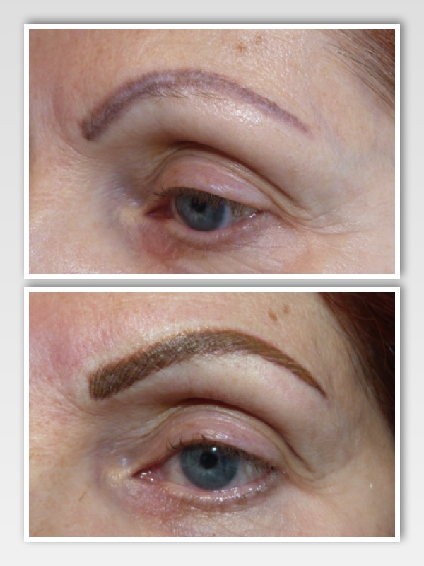 2 sessions of color removal were necessary to allow for adjustment of the shape.