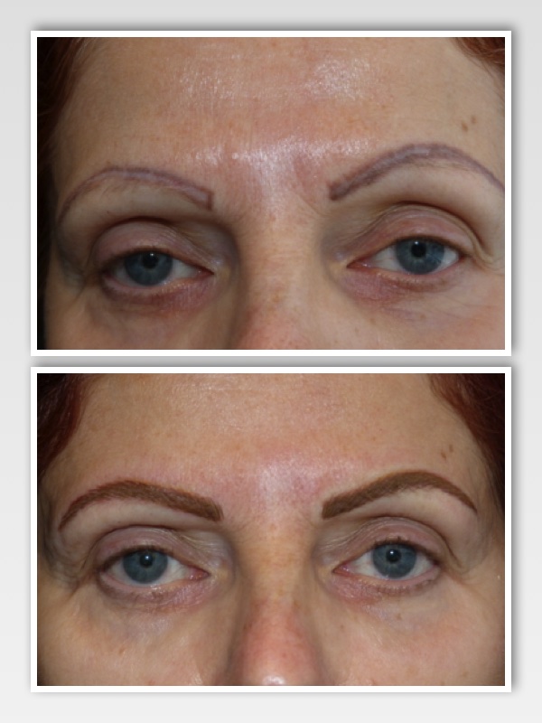 Although never as perfect as if we had been able to start with a blank canvas, this client's brows are significantly improved!