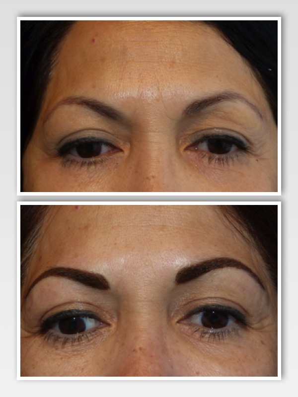Client presented with eyebrow tattoo that had faded to a purple color. This was the result of too much red base in a cool (blue) brown pigment - when combined with her skin tones changed with fading to an esthetically unpleasing tone. Brows were also designed too thin for client's high brow bone structure.