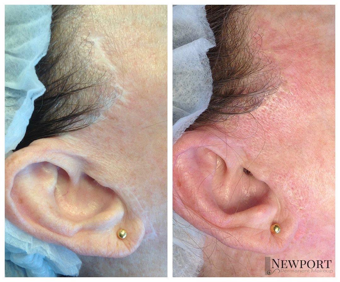 Before and after facelift scar camouflage