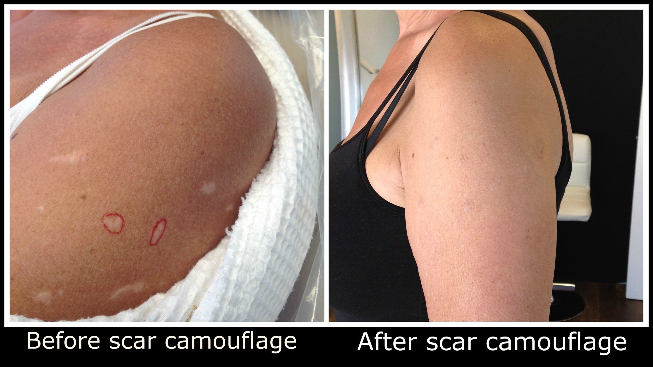 Scar Camouflage — Newport Permanent Makeup