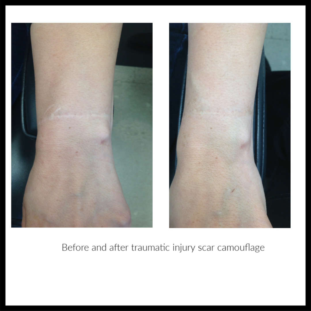 Camouflage Makeup For Scars On Legs Saubhaya Makeup