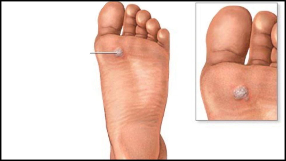 squamous papilloma foot)