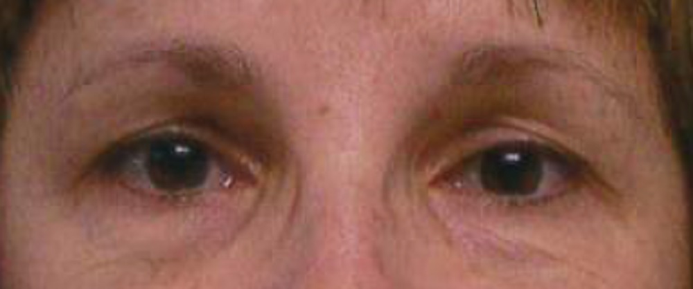 Before brow and eyeliner
