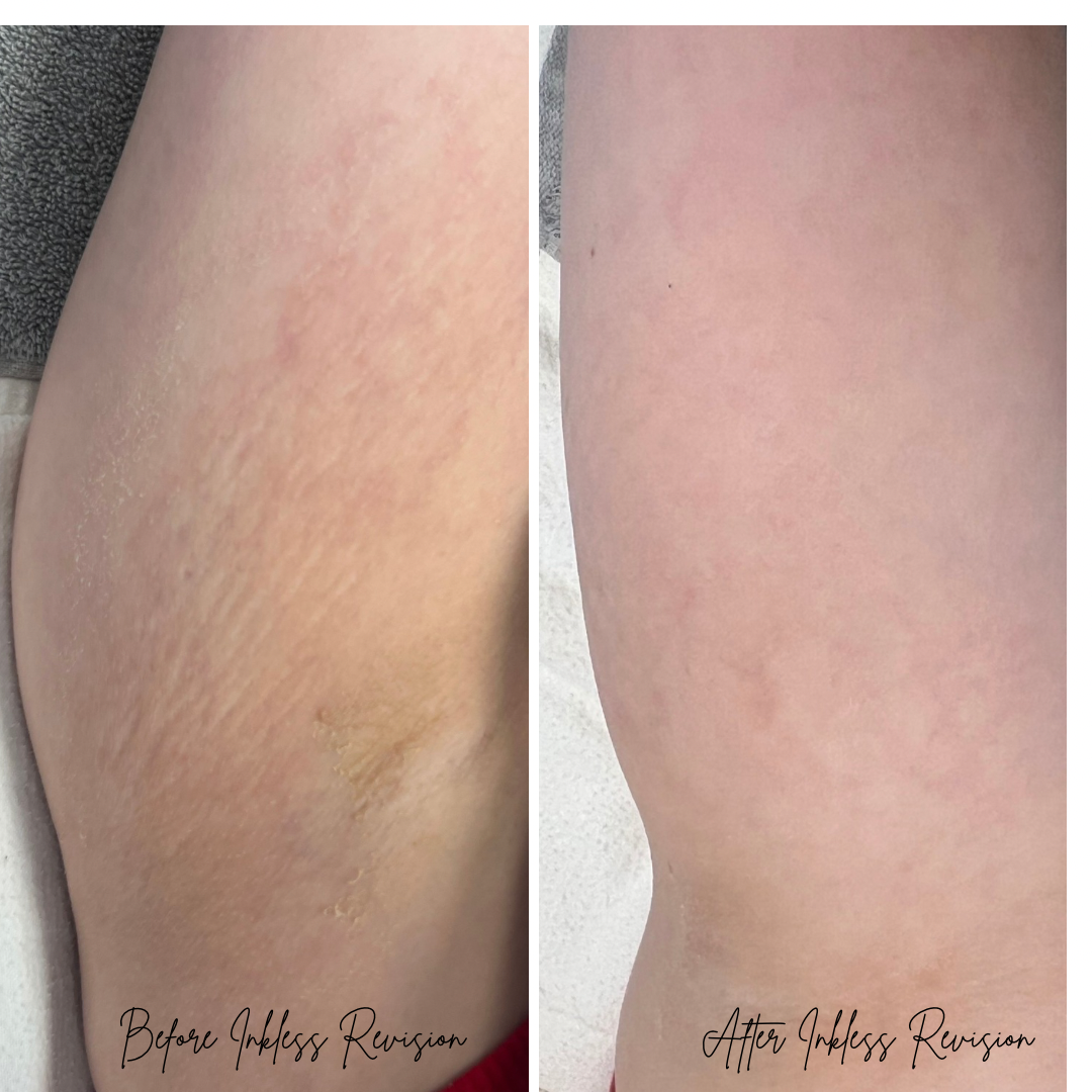 before and after results of inkless stretch mark and scar revision in St. Louis