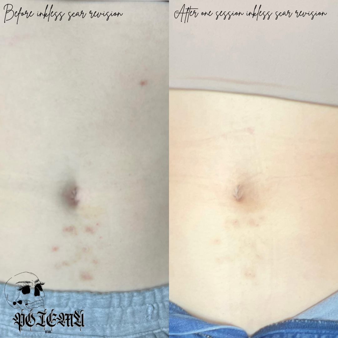 before and after results of inkless scar revision in St. Louis
