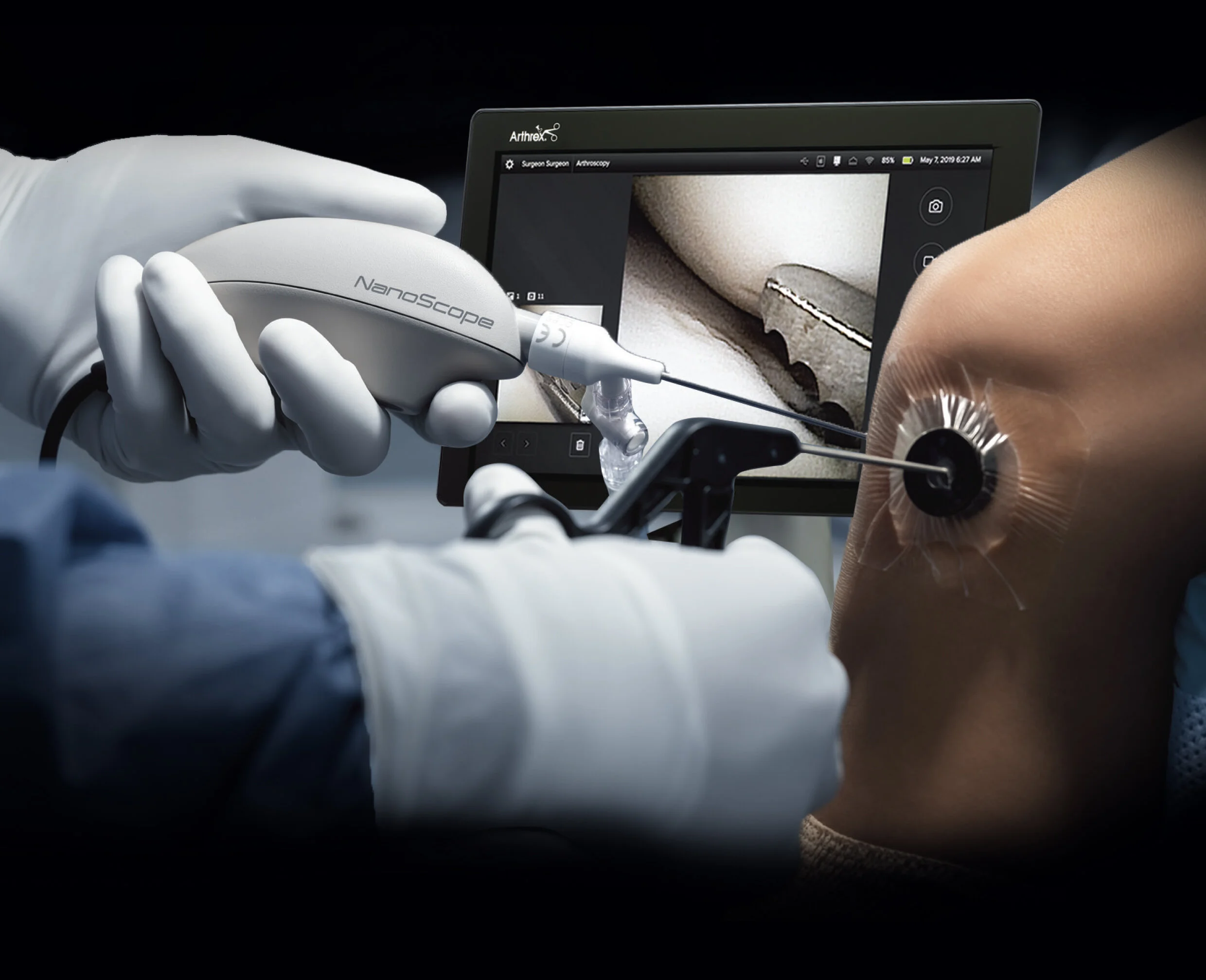 NanoScope Nano Operative Arthroscopy System - in use knee.jpg