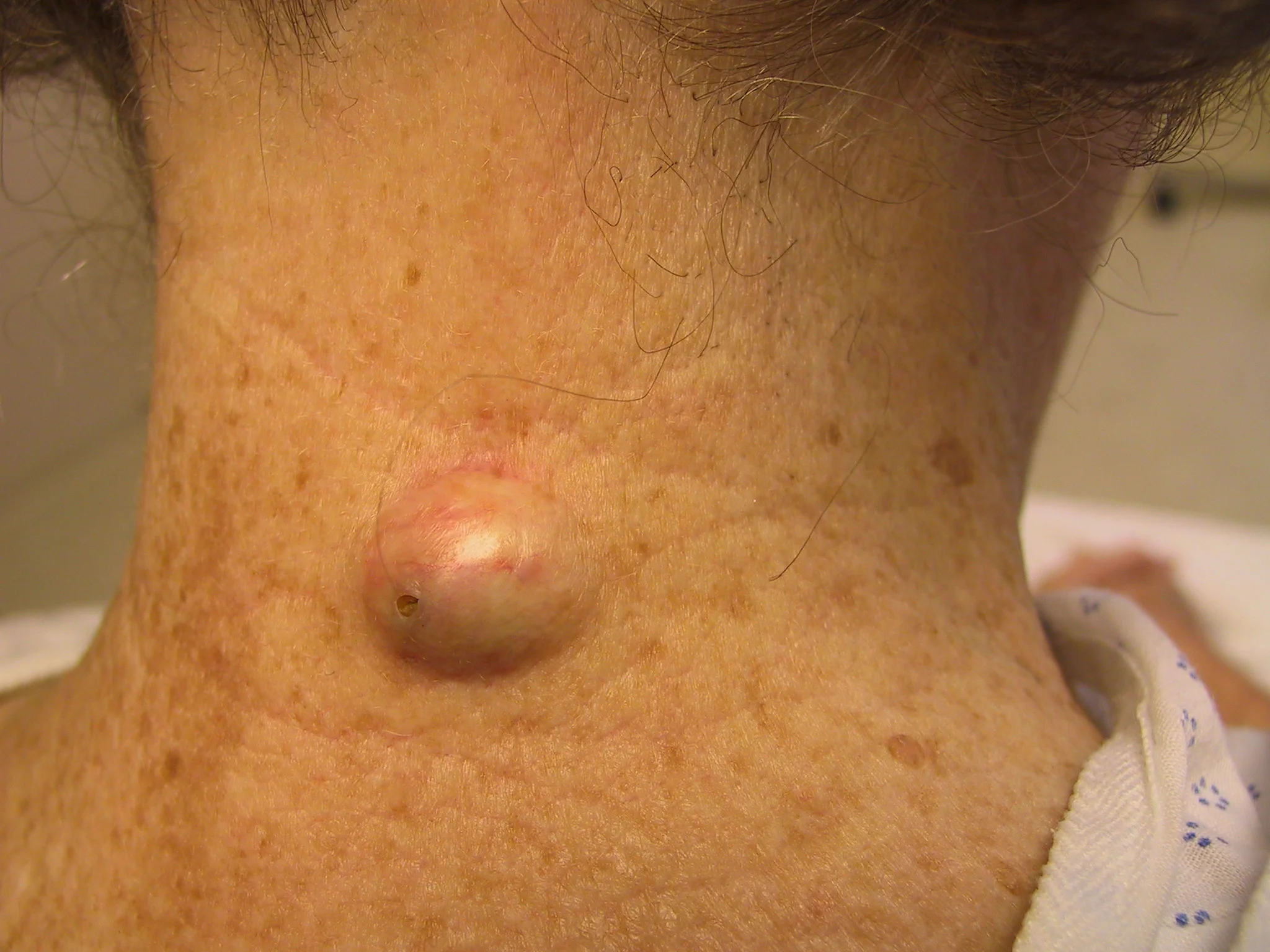 cyst.jpg
