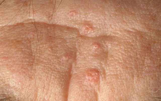 Sebaceoushyperplasia3.jpg