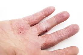 hand eczema.jpeg