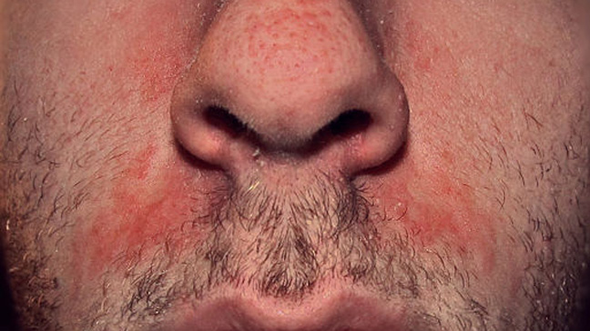 seborrheic dermatitis.jpeg