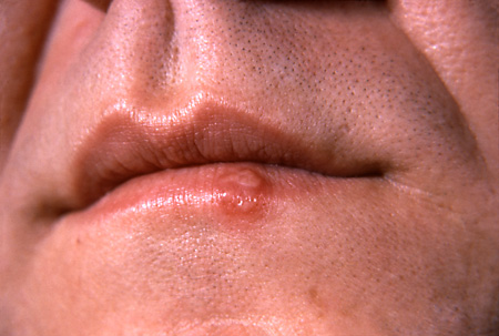 cold-sore.jpg