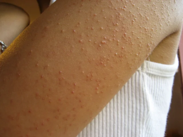 Keratosis Pilaris — Dr. Michelle Levy