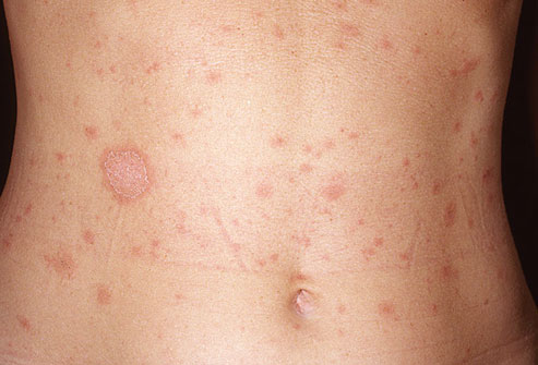 Pityriasis-rosea-pic.jpg
