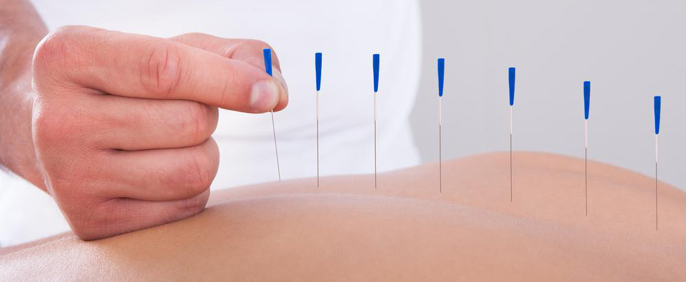 dry-needling.jpg