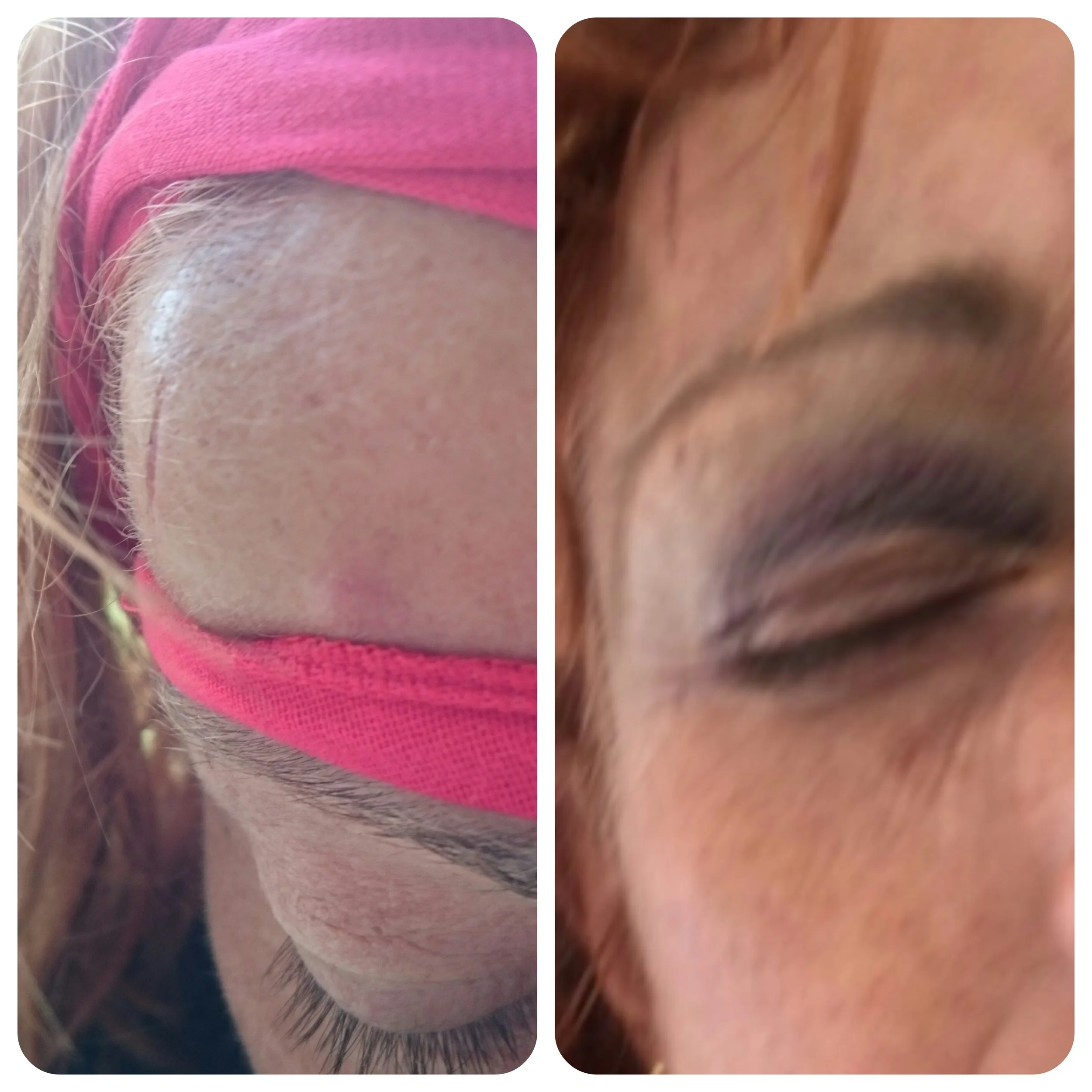 Bump which is now a black eye