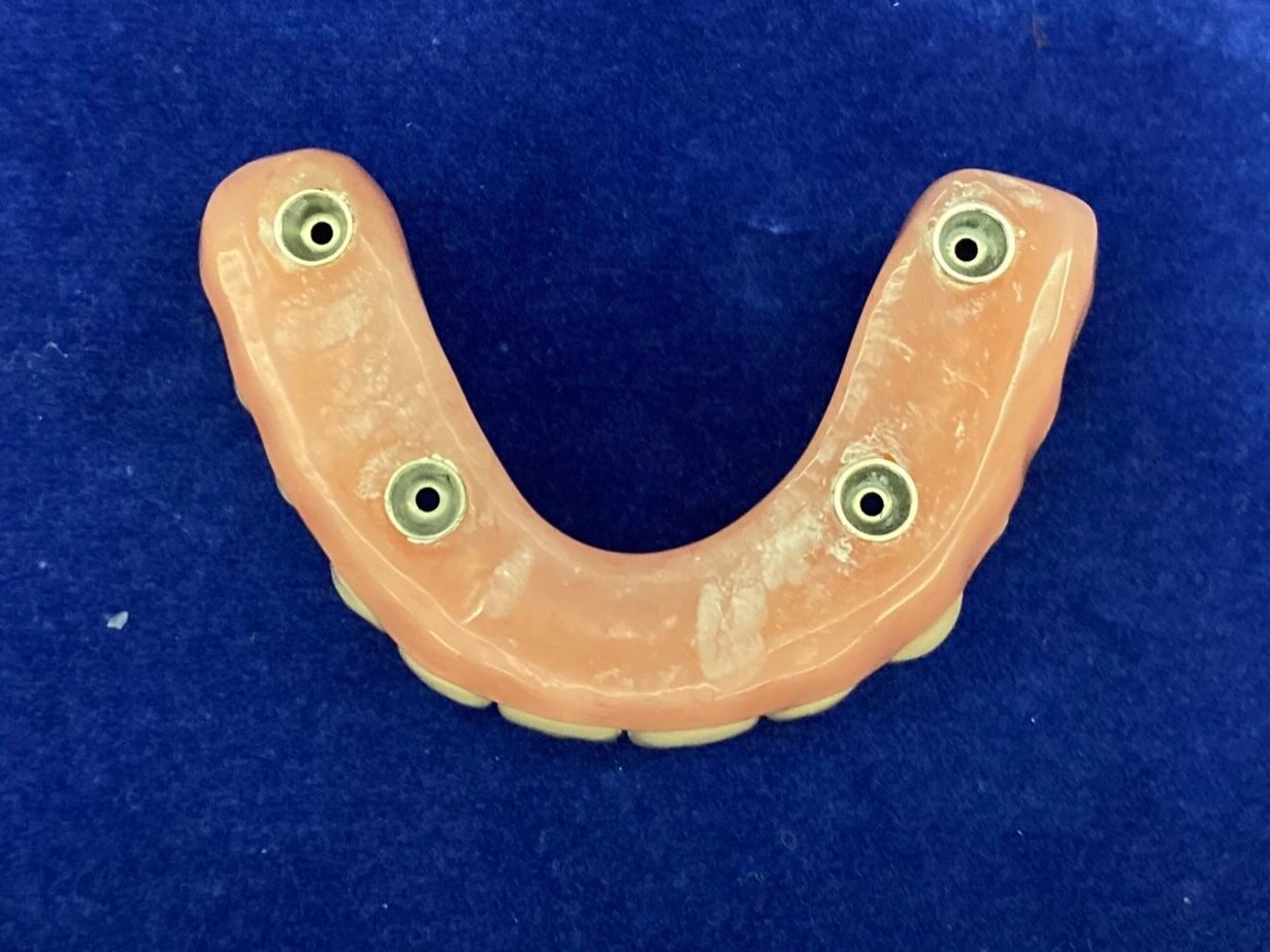 View of underside of denture
