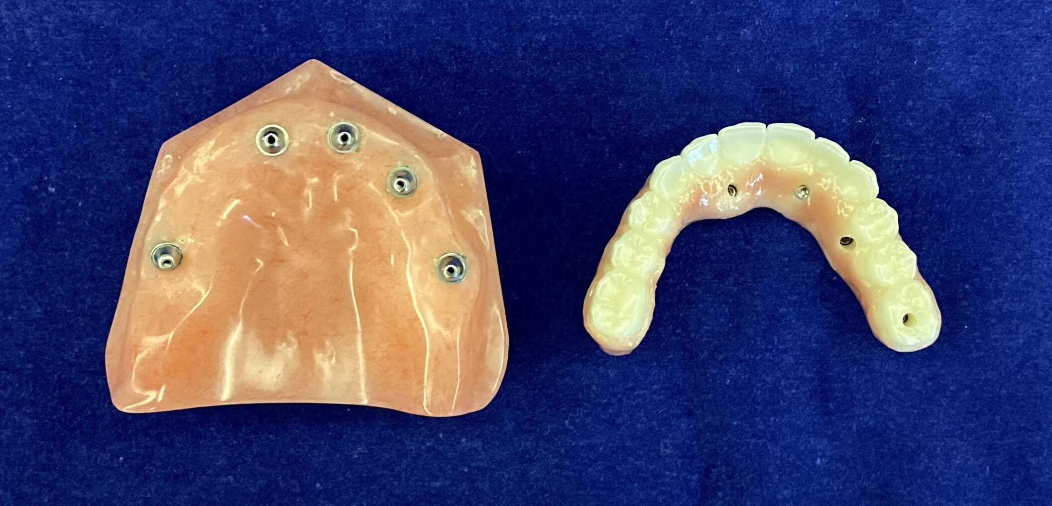 View from top of denture and palate when denture removed